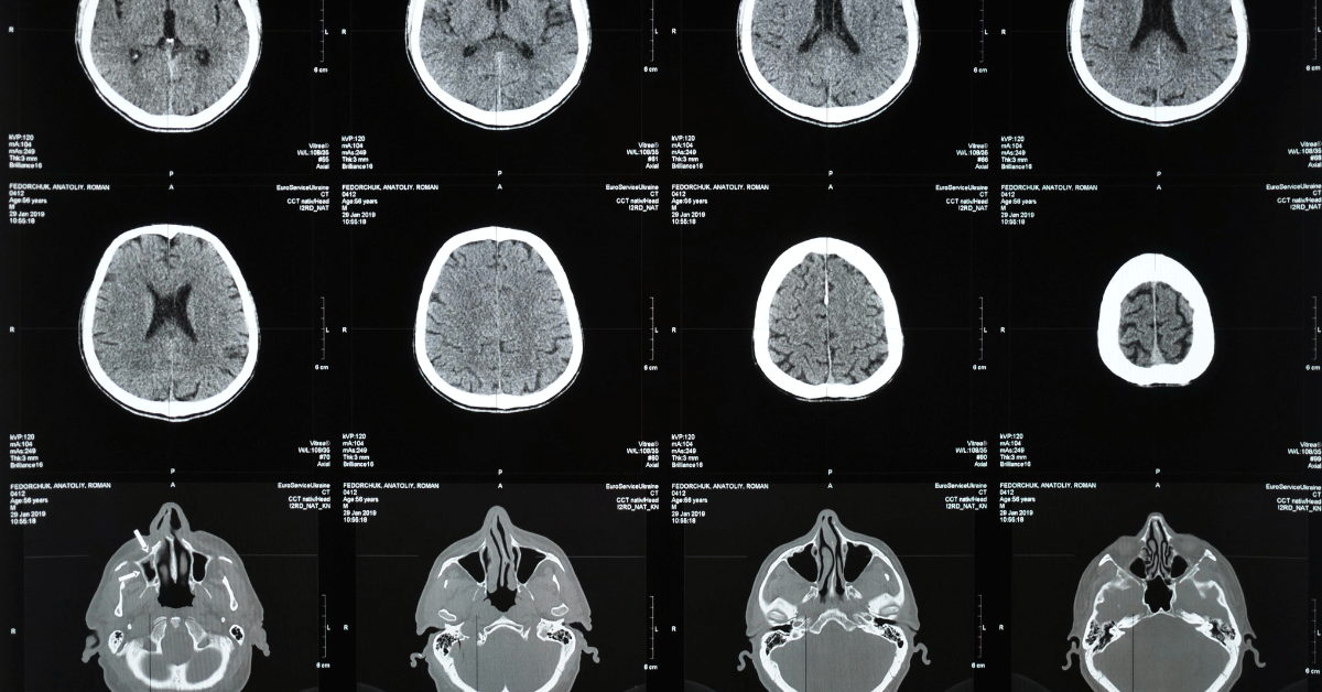 Discover how drug addiction changes the brain with this informative image. Understand the impact of substance abuse on brain function and the long-term effects of addiction. Gain valuable insights into the science behind drug addiction and the need for effective treatment options. Explore this image and gain a deeper understanding of the devastating effects of addiction on the brain.